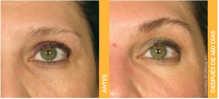 Close-up de antes e depois das sobrancelhas de uma paciente real do Ultherapy<sup>&reg;</sup>, mostrando resultados de lifting após 450 dias.