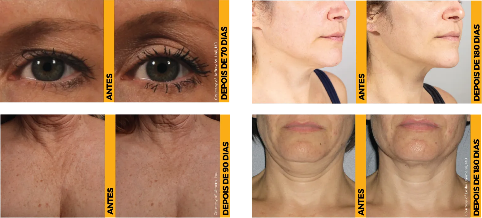 Quatro fotos de antes e depois mostrando resultados comprovados de lifting na sobrancelha, queixo, colo e pescoço.