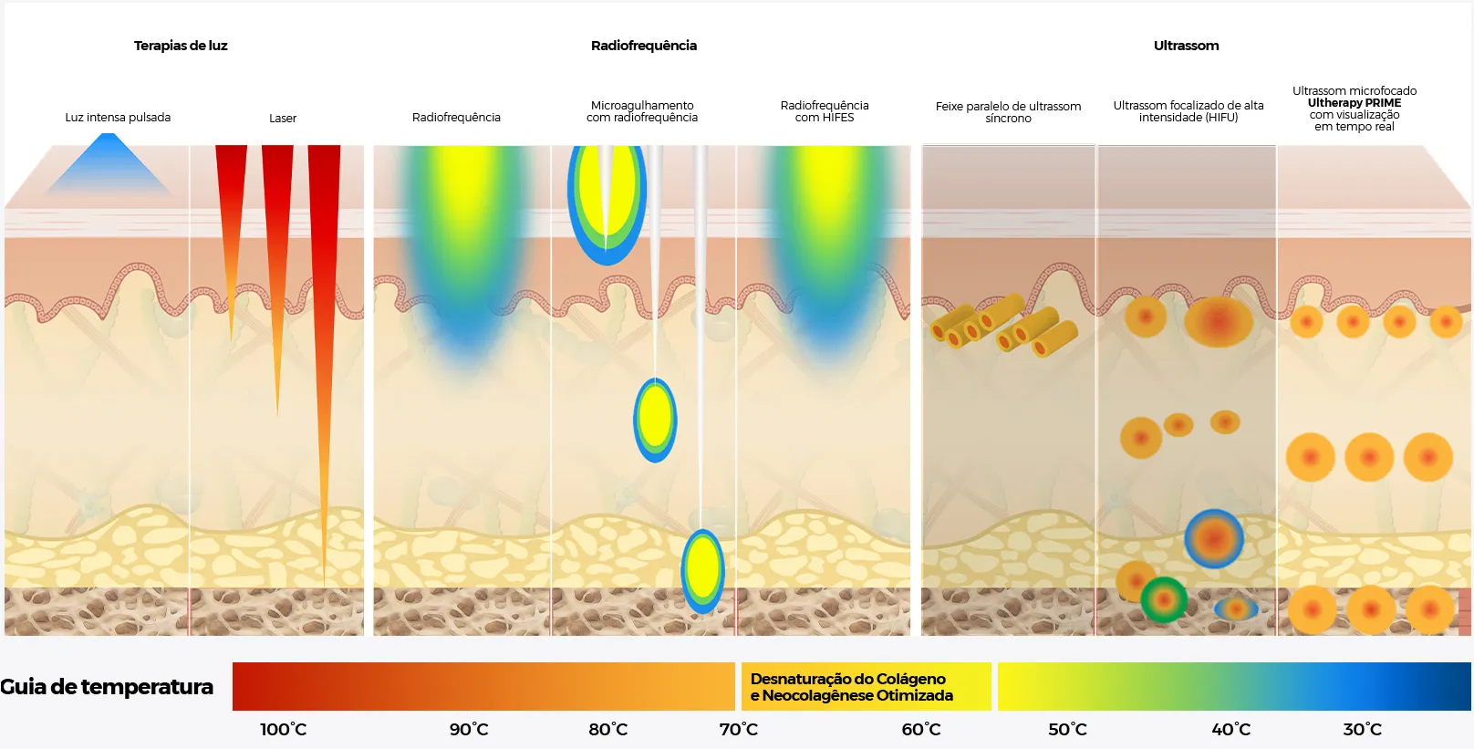 Diagrama comparando a profundidade do Ultherapy<sup>&reg;</sup> em relação à luz, radiofrequência e outros tratamentos de ultrassom nas camadas da pele.