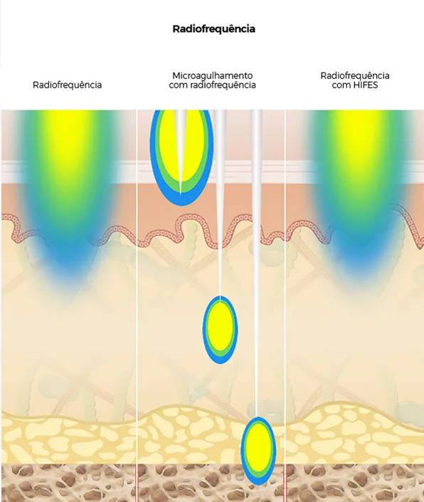 Diagrama comparando terapias de radiofrequência com a penetração mais profunda do Ultherapy<sup>&reg;</sup> nas camadas da pele.