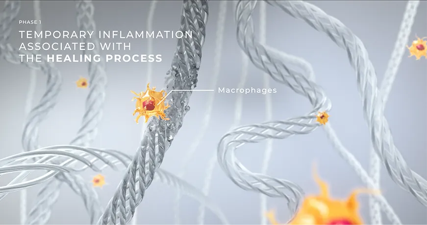Visualização dos macrófagos durante a Fase 1 da cicatrização, mostrando inflamação temporária e reparo tecidual.
