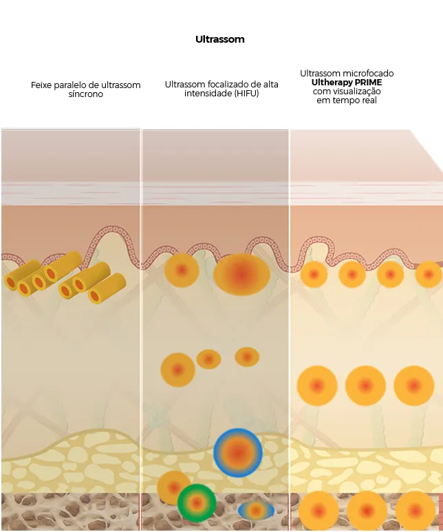 Diagrama comparando outros tratamentos de ultrassom com a penetração mais profunda do Ultherapy<sup>&reg;</sup> nas camadas da pele.