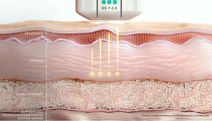 Diagrama do Ultherapy PRIME® mostrando o ultrassom microfocado criando pontos de coagulação térmica em profundidades precisas da pele.