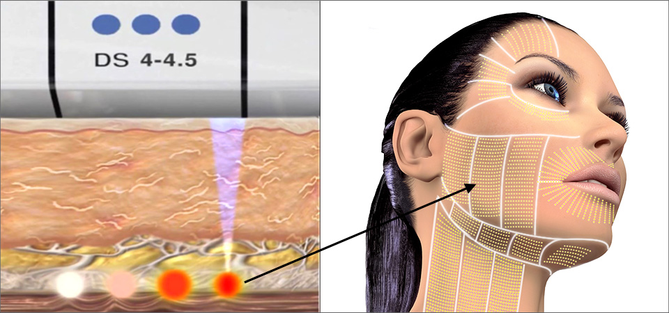 Ultherapy creates micro-coagulation points at 3 depths below the skin's surface Ultherapy creates micro-coagulation points at 3 depths below the skin's surface