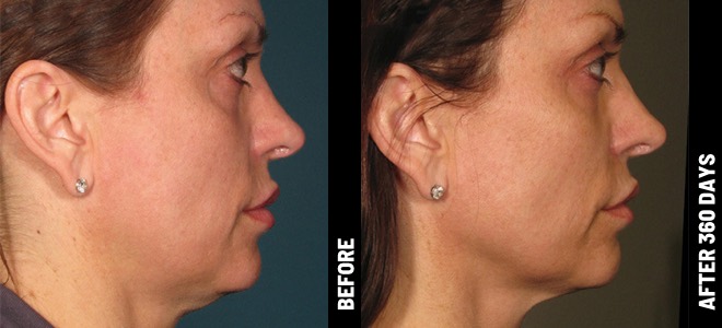 Imagens lado a lado de antes e depois mostrando resultados de lifting e firmeza da pele após o Ultherapy. Diana, 62