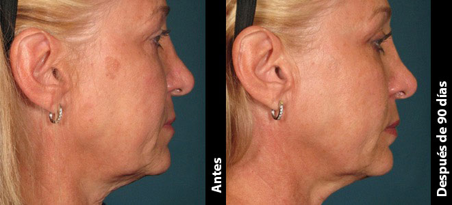 Imagens lado a lado de antes e depois mostrando resultados de lifting e firmeza da pele após o Ultherapy. 