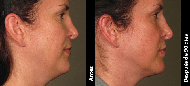 Imagens lado a lado de antes e depois mostrando resultados de lifting e firmeza da pele após o Ultherapy. 