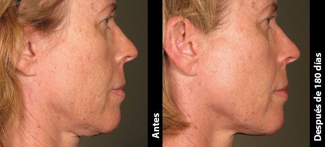 Imagens lado a lado de antes e depois mostrando resultados de lifting e firmeza da pele após o Ultherapy. 