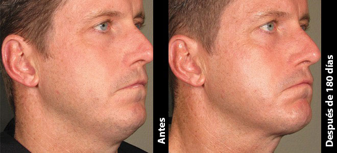 Imagens lado a lado de antes e depois mostrando resultados de lifting e firmeza da pele após o Ultherapy. 