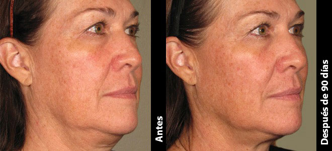 Imagens lado a lado de antes e depois mostrando resultados de lifting e firmeza da pele após o Ultherapy. 