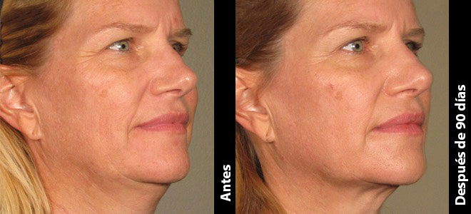 Imagens lado a lado de antes e depois mostrando resultados de lifting e firmeza da pele após o Ultherapy. 