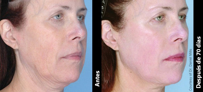 Imagens lado a lado de antes e depois mostrando resultados de lifting e firmeza da pele após o Ultherapy. 