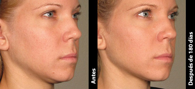 Imagens lado a lado de antes e depois mostrando resultados de lifting e firmeza da pele após o Ultherapy. 