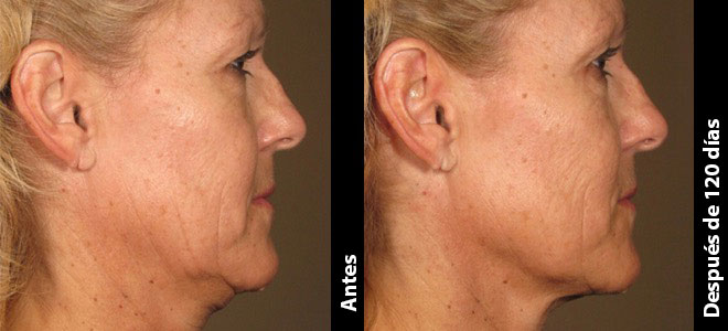 Imagens lado a lado de antes e depois mostrando resultados de lifting e firmeza da pele após o Ultherapy. 