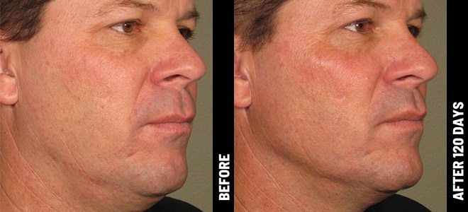Imagens lado a lado de antes e depois mostrando resultados de lifting e firmeza da pele após o Ultherapy. 
