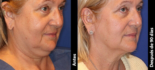 Imagens lado a lado de antes e depois mostrando resultados de lifting e firmeza da pele após o Ultherapy. 