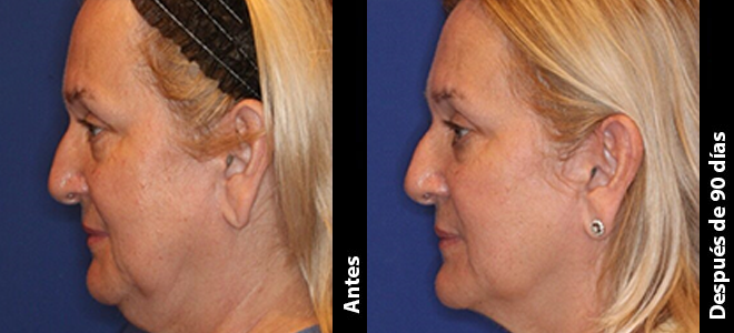 Imagens lado a lado de antes e depois mostrando resultados de lifting e firmeza da pele após o Ultherapy. 