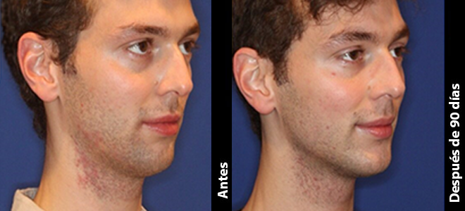 Imagens lado a lado de antes e depois mostrando resultados de lifting e firmeza da pele após o Ultherapy. 