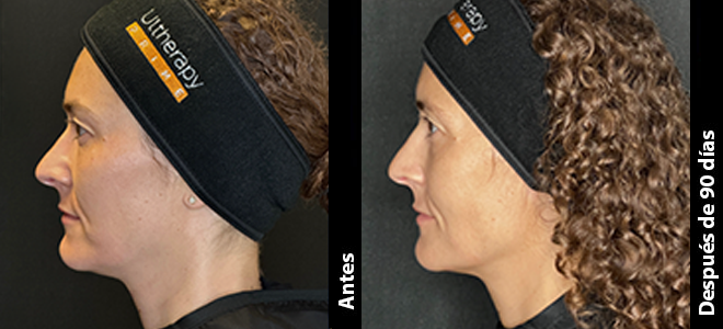 Imagens lado a lado de antes e depois mostrando resultados de lifting e firmeza da pele após o Ultherapy. 