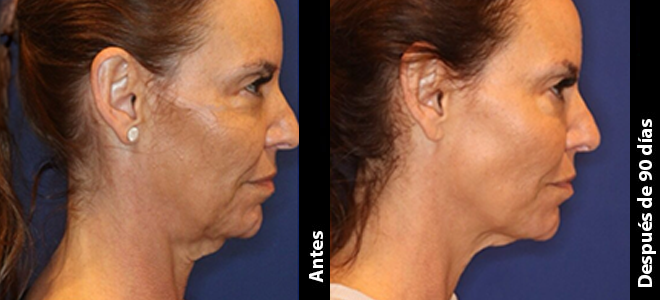 Imagens lado a lado de antes e depois mostrando resultados de lifting e firmeza da pele após o Ultherapy. 