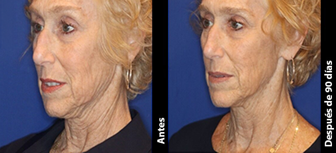 Imagens lado a lado de antes e depois mostrando resultados de lifting e firmeza da pele após o Ultherapy. 