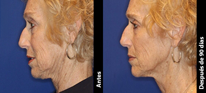 Imagens lado a lado de antes e depois mostrando resultados de lifting e firmeza da pele após o Ultherapy. 