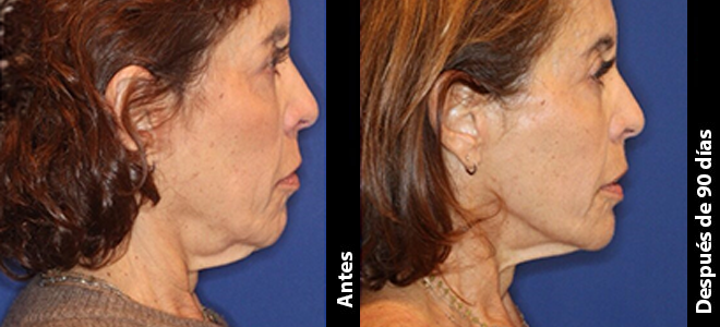 Imagens lado a lado de antes e depois mostrando resultados de lifting e firmeza da pele após o Ultherapy. 