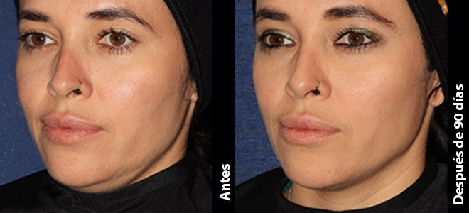 Imagens lado a lado de antes e depois mostrando resultados de lifting e firmeza da pele após o Ultherapy. 